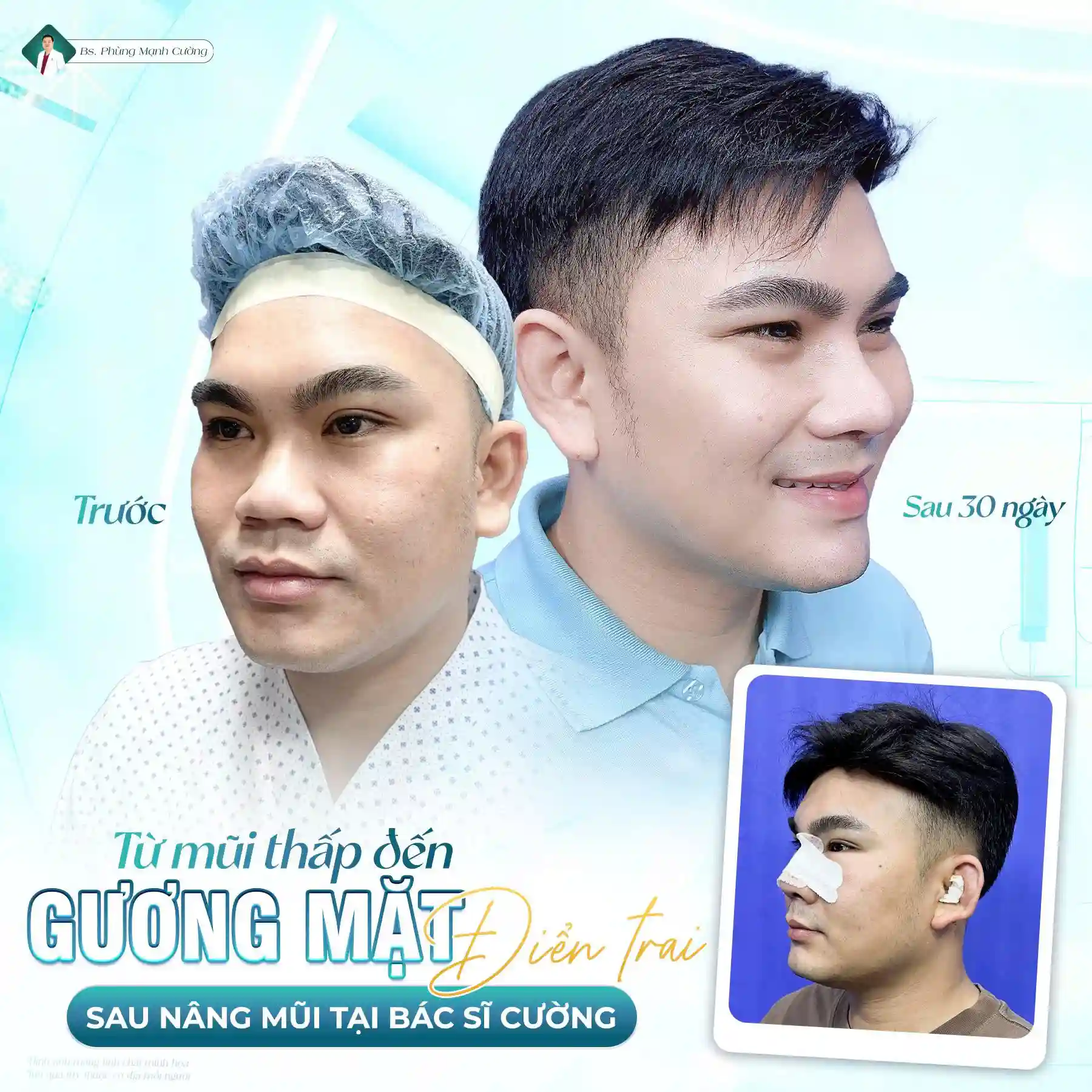 CÁC TIÊU CHÍ ĐỂ CHỌN NƠI NÂNG MŨI BỌC SỤN CHẤT LƯỢNG