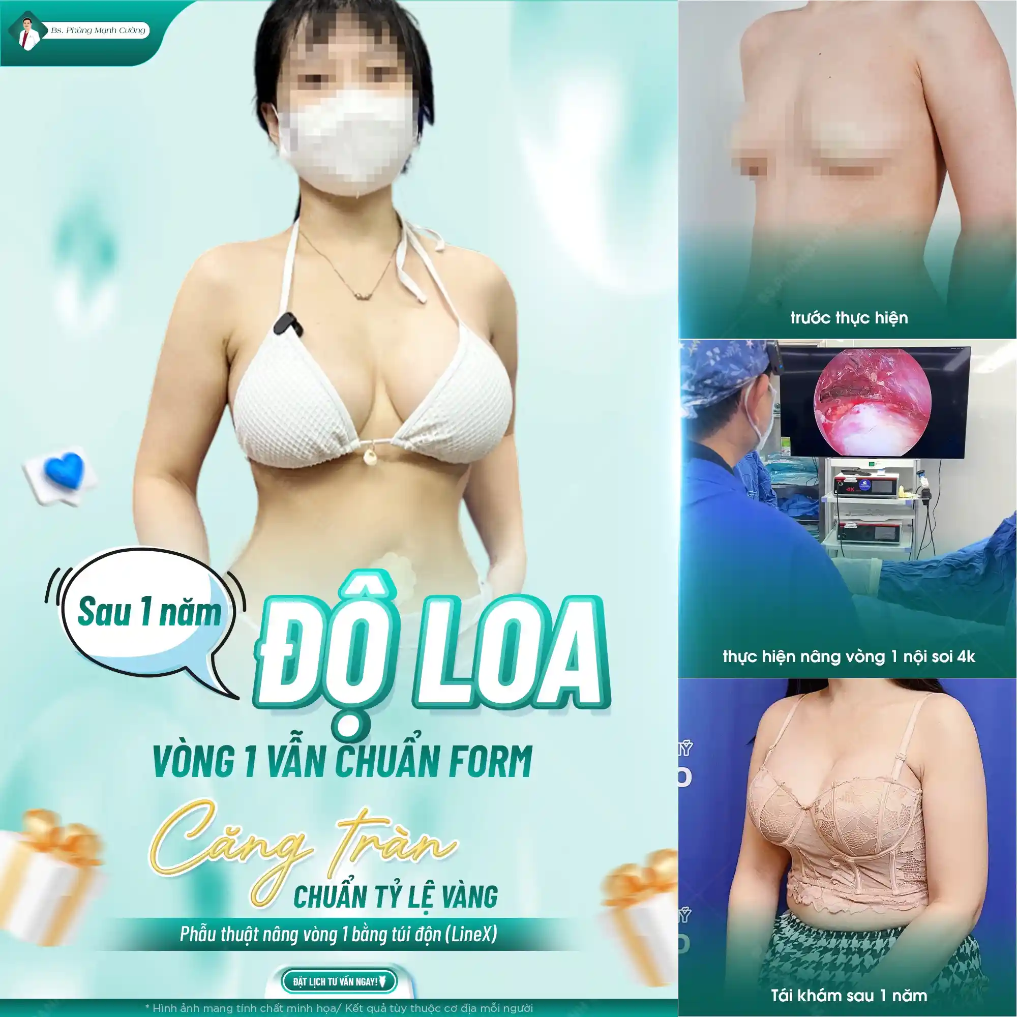 Thay túi độn ngực thường thực hiện sau 10 - 20 năm