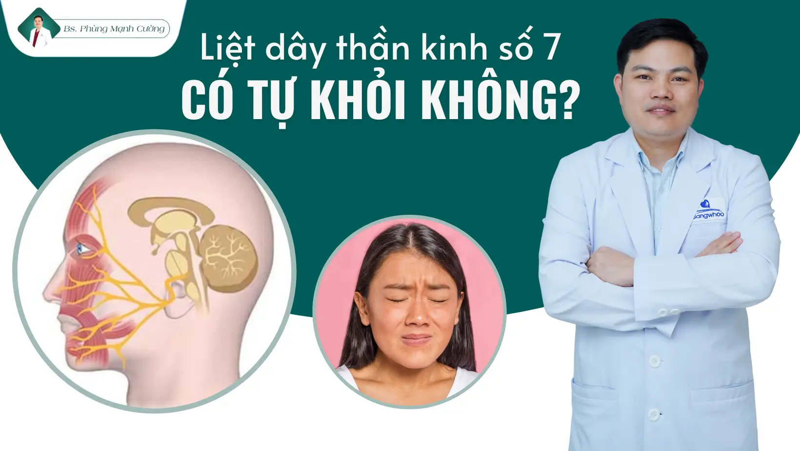 Liệt Dây Thần Kinh Số 7 Có Tự Khỏi Không?