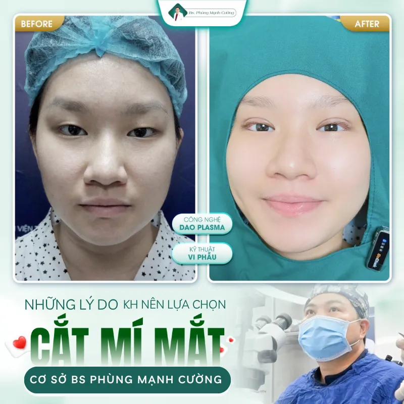 Cắt mí bao nhiêu tiền? Giá cắt mí mắt mới nhất hiện nay 28 Cắt mắt 2 mí uy tín, an toàn tại bác sĩ Phùng Mạnh Cường