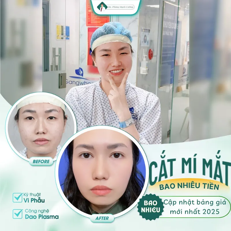 Cắt mí bao nhiêu tiền? Giá cắt mí mắt mới nhất hiện nay 22 Tìm hiểu giá cắt mí mắt tại các cơ sở uy tín