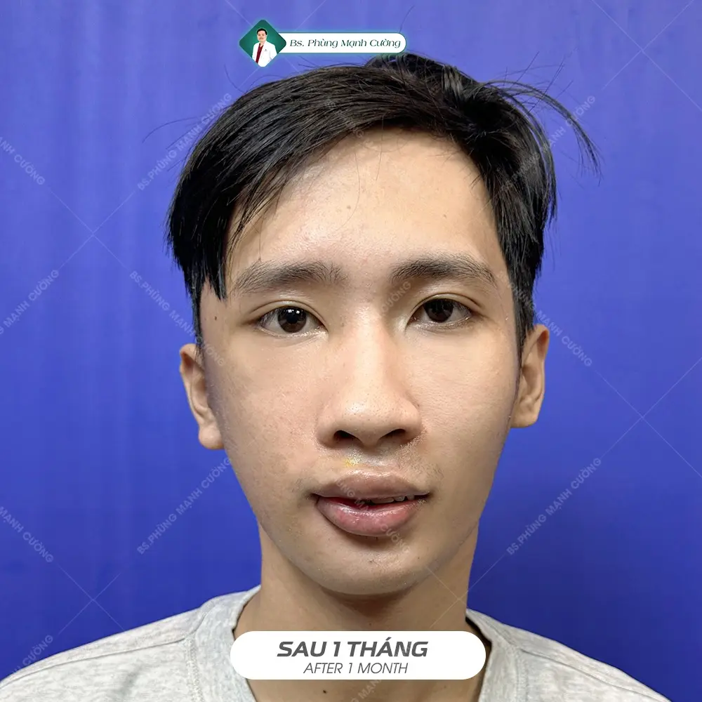 Liệt Dây Thần Kinh Số 7 Lâu Năm Có Chữa Khỏi Không?