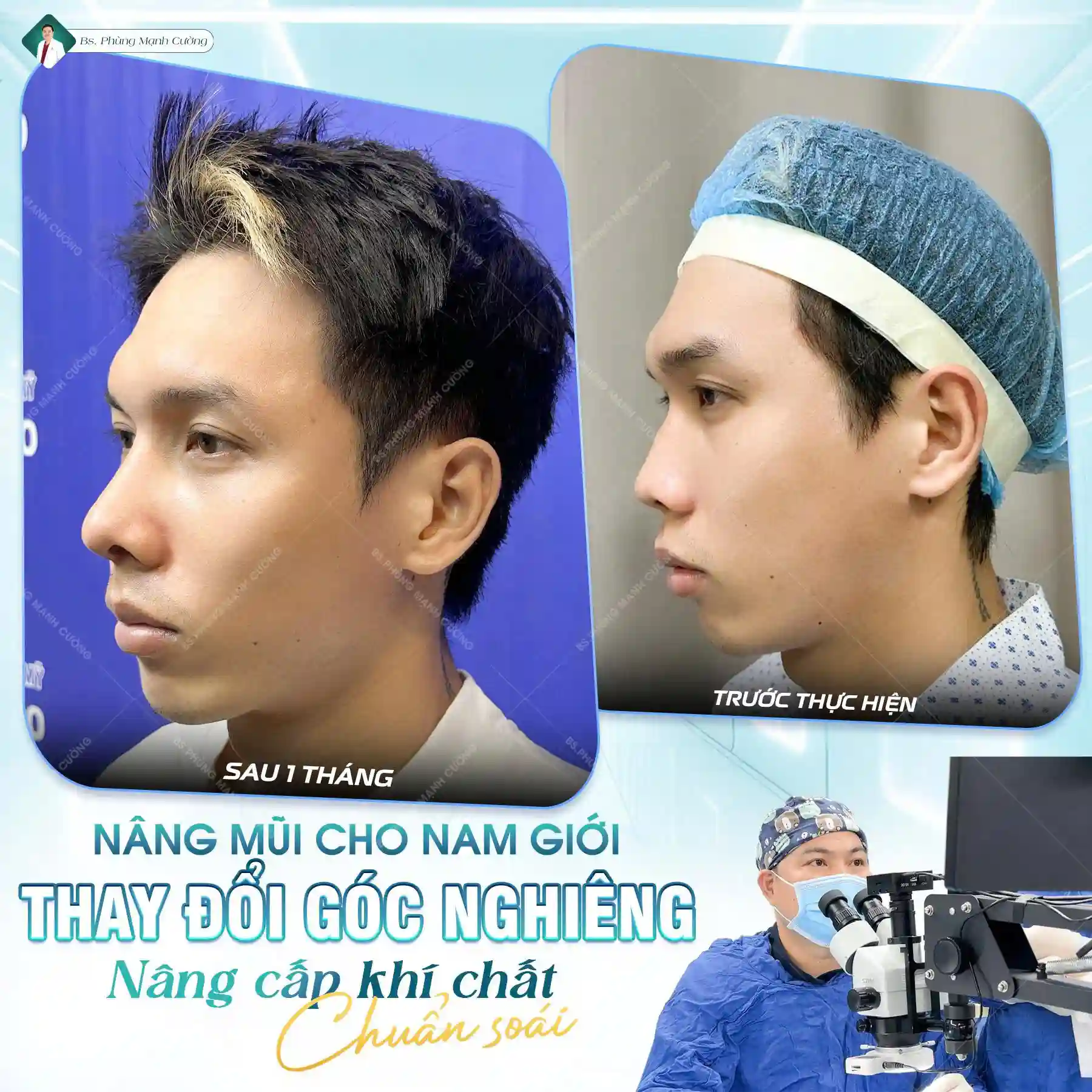 Nâng mũi bao lâu thì hết sưng? Cách giảm sưng sau nâng mũi 7 Thông thường mũi sẽ hết sưng sau 5-7 ngày phẫu thuật