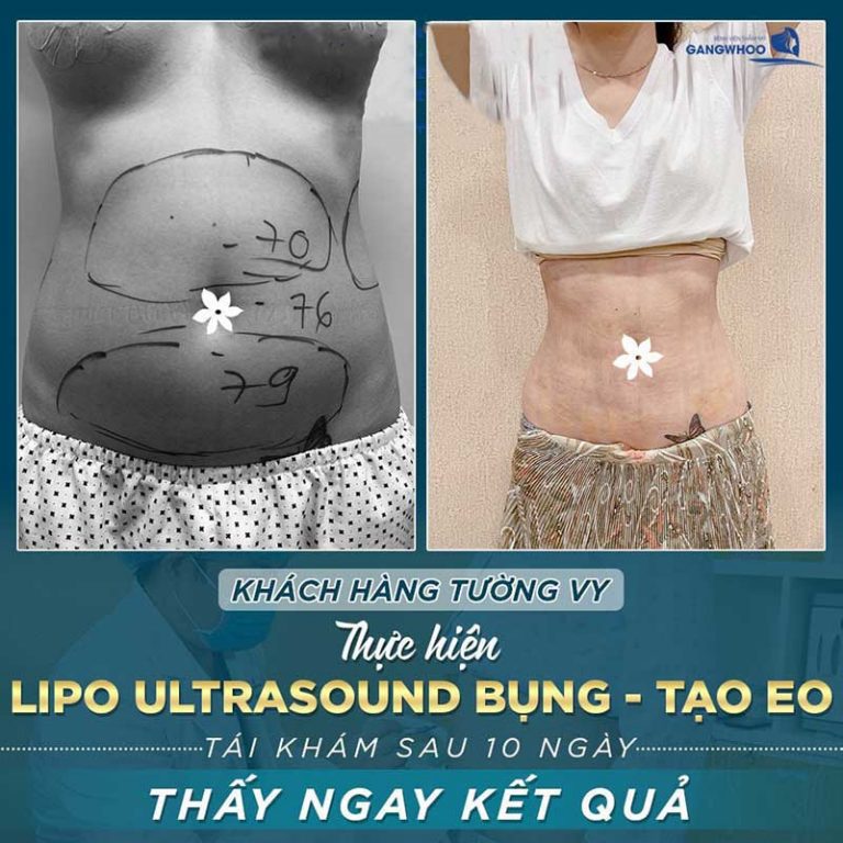 lipo ultrasound bvtm 1 768x768 1