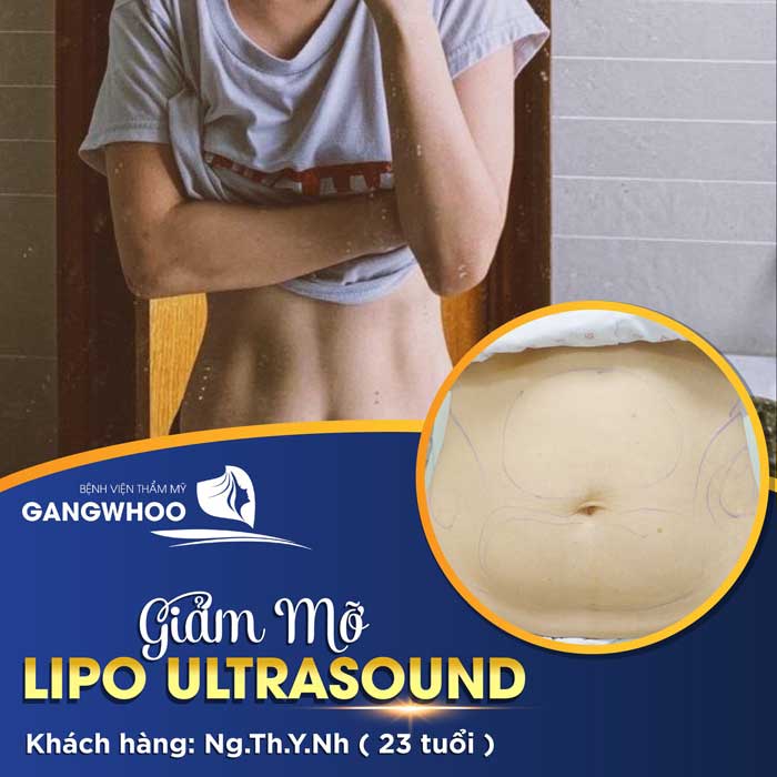 lipo ultrasound bvtm gangwhoo 5