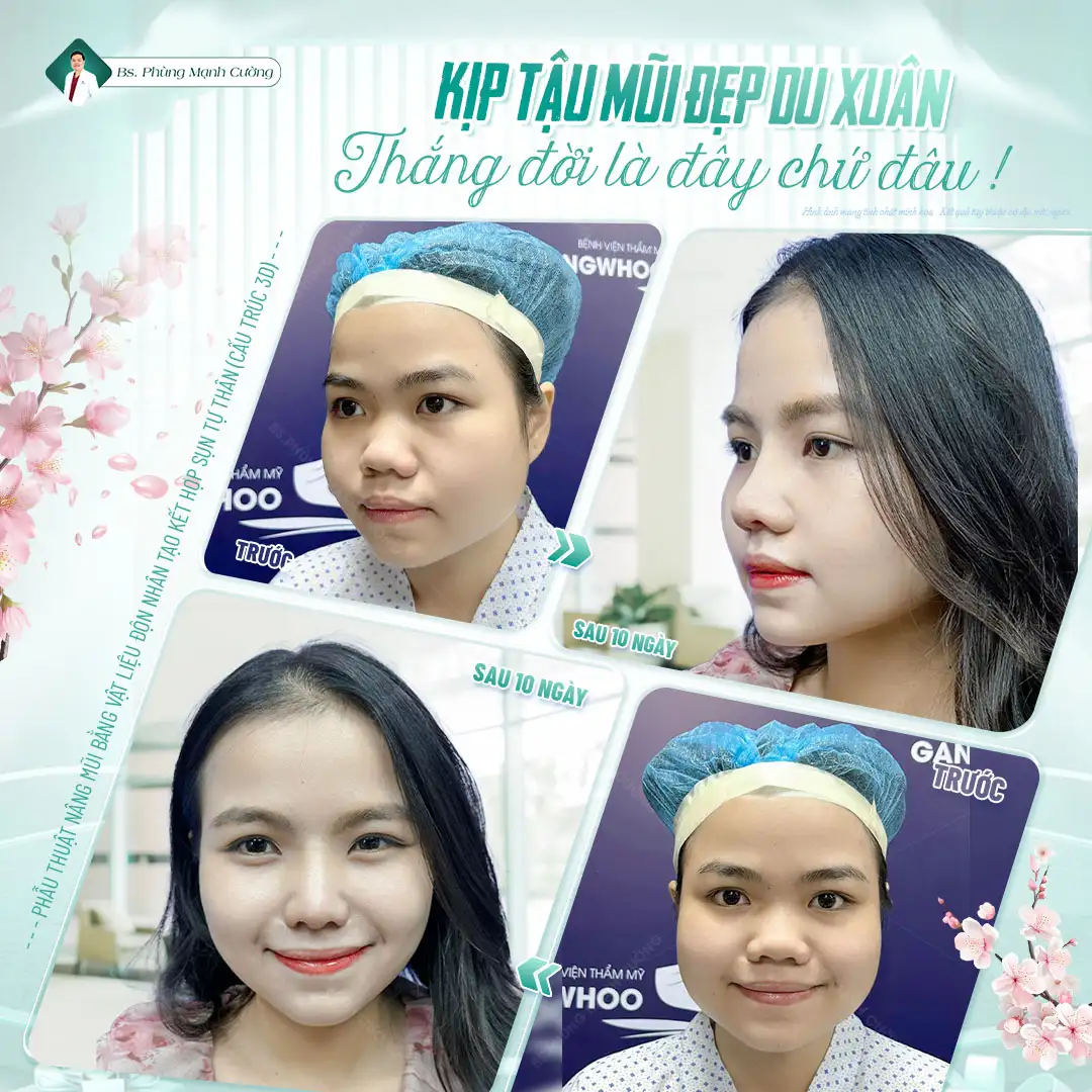 Nâng mũi có đau không? Sau bao lâu thì hết đau 12 Các giai đoạn phục hồi sau nâng mũi