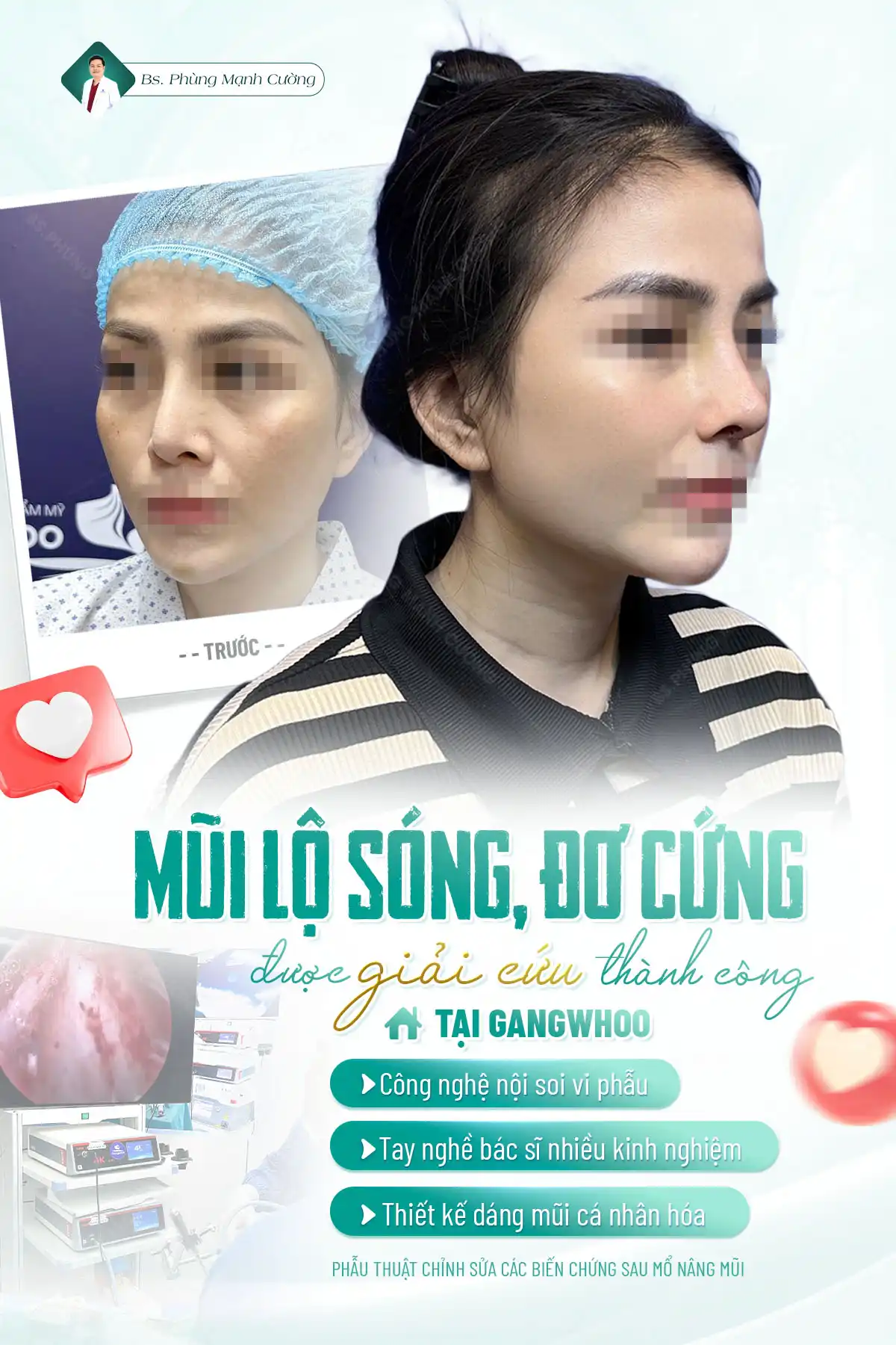 Nâng mũi có đau không? Sau bao lâu thì hết đau 17 Những trường hợp nên thực hiện nâng mũi