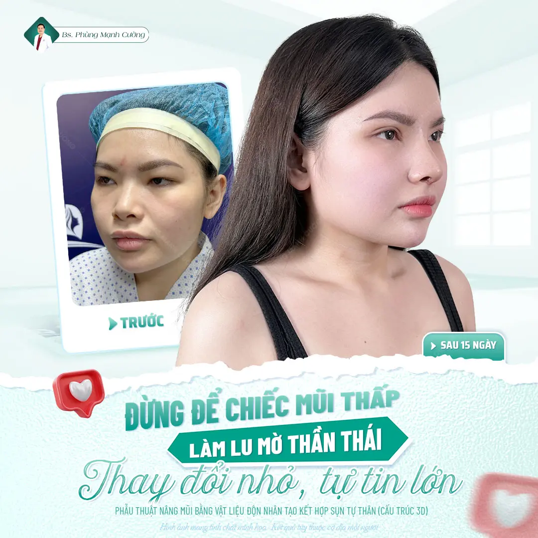 Nâng mũi có đau không? Sau bao lâu thì hết đau 13 Thông thường 7-8 giờ sau khi nâng mũi sẽ hết cảm giác tê nhức