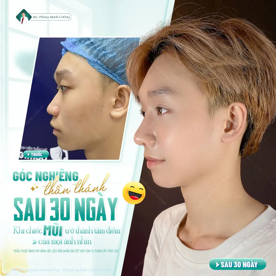 Nâng mũi được bao lâu? Nâng mũi có vĩnh viễn không? 10 Nâng mũi thường mang lại kết quả kéo dài từ 10 đến 20 năm hoặc vĩnh viễn