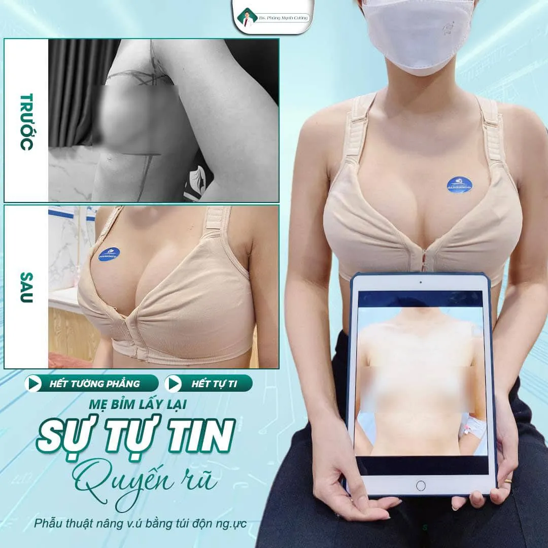 Những đối tượng nên thực hiện phương pháp nâng ngực bằng đường nách