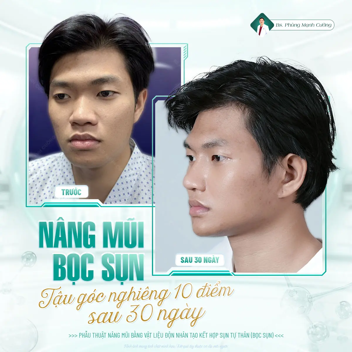 Nâng mũi bọc sụn tạo sống mũi hoàn toàn tự nhiên