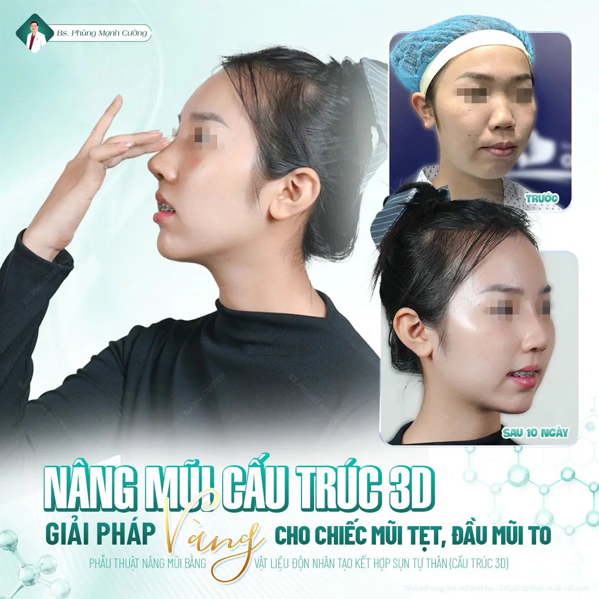 Nâng mũi cấu trúc tái tạo dáng mũi toàn diện