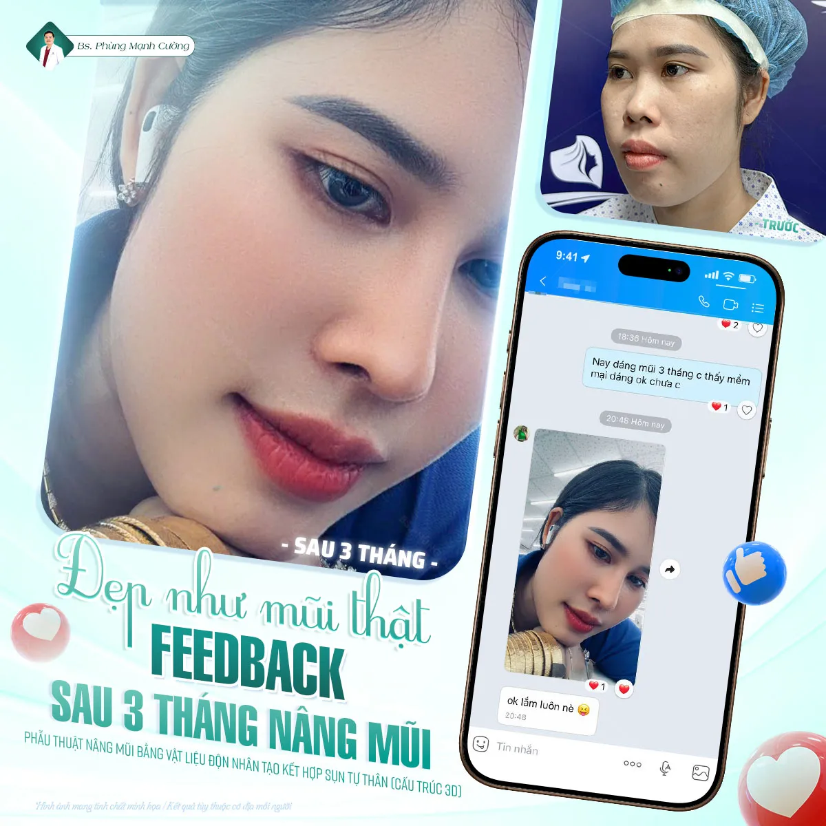 Nâng mũi sụn tự thân là một trong những phương pháp phổ biến