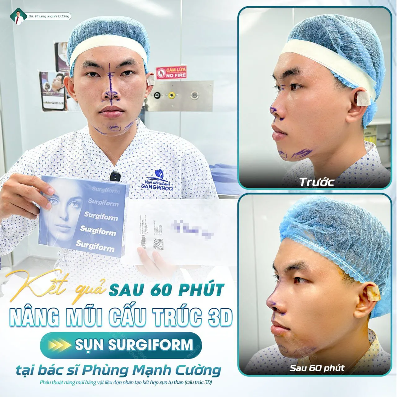 Giải đáp da mũi mỏng có nâng mũi được không