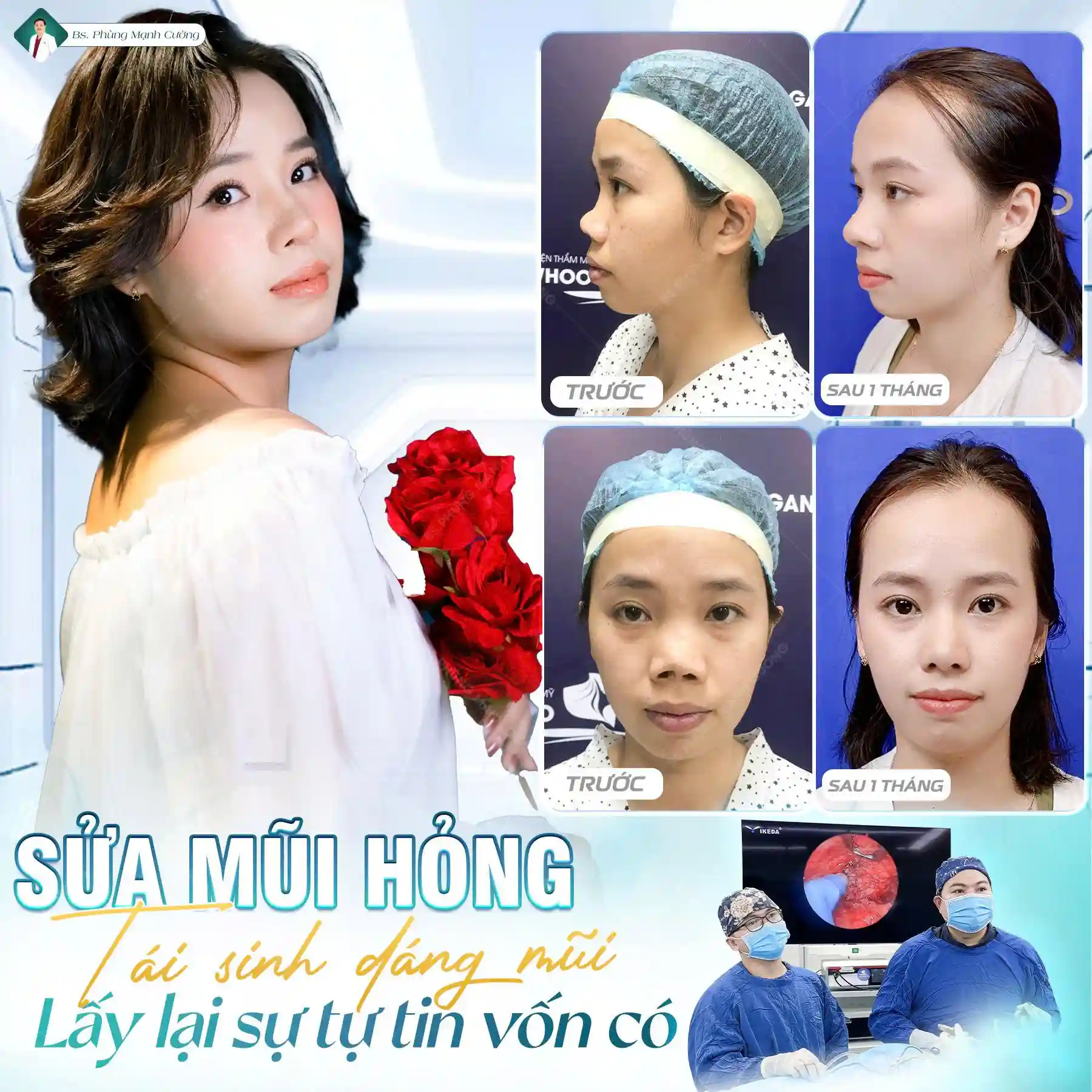 Ưu điểm của nâng mũi cấu trúc trong chỉnh hình mũi