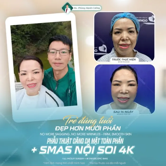 Căng Da Mặt (Perfect) Níu Giữ Thanh Xuân, Ngăn Chặn Lão Hóa