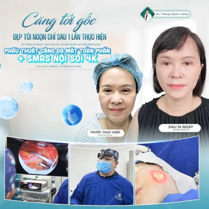 Căng Da Mặt (Perfect) Níu Giữ Thanh Xuân, Ngăn Chặn Lão Hóa