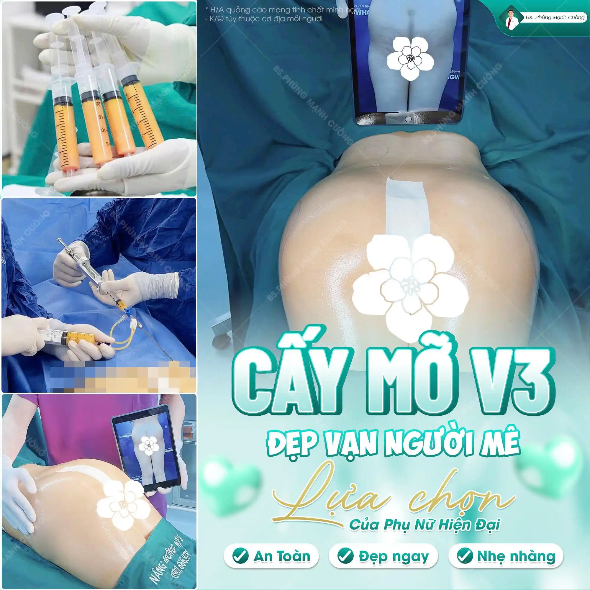 Nâng mông bằng mỡ tự thân là gì? Có an toàn không?