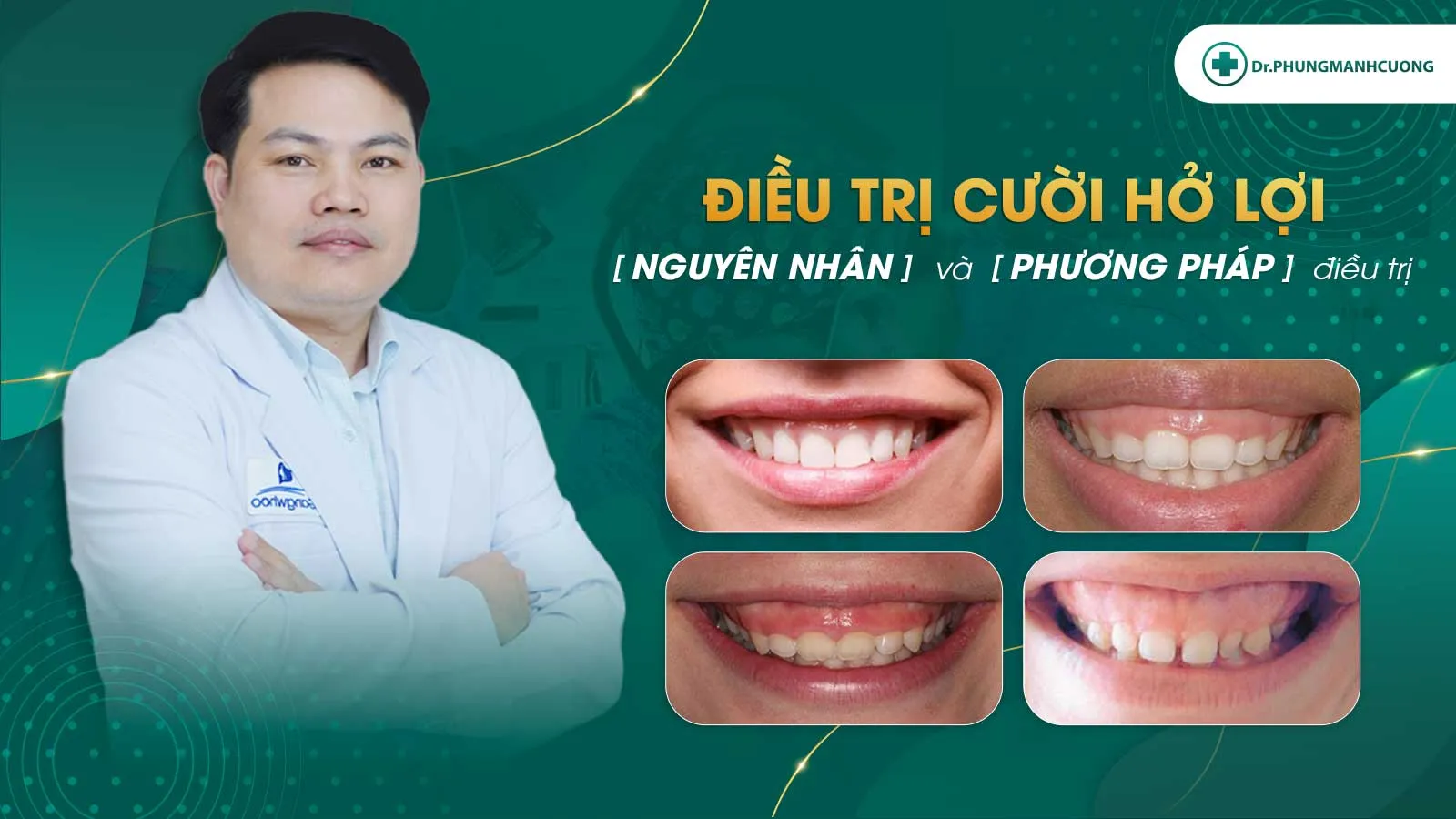 Điều trị cười hở lợi