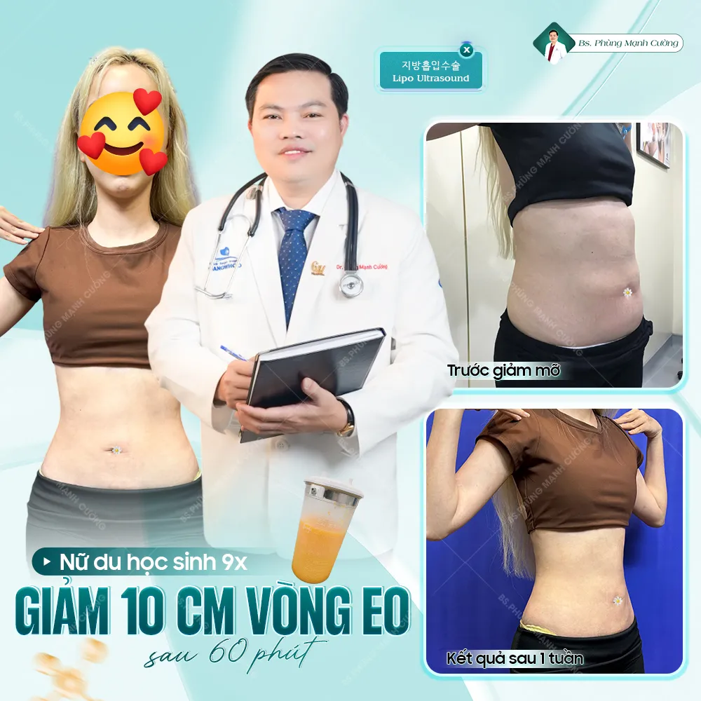 Hút mỡ bụng là gì? Những điều cần biết trước khi thực hiện 42 Hút Mỡ Bụng Toàn Phần An Toàn, Không Đau Cho Vòng Eo Cân Đối