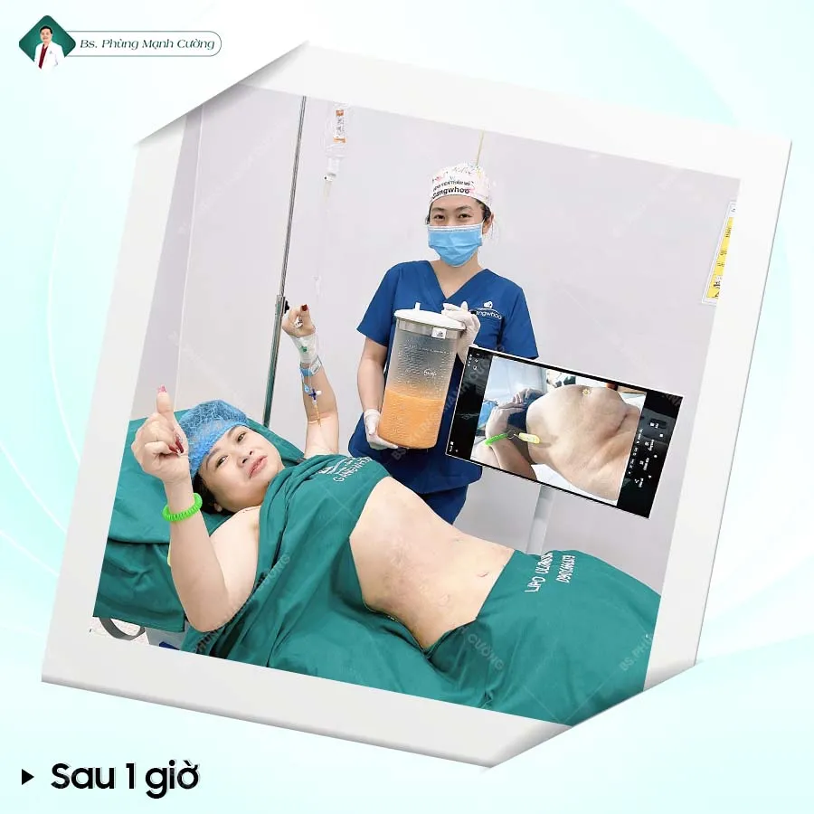 Hút mỡ bụng là gì? Những điều cần biết trước khi thực hiện 26 Hút Mỡ Bụng Toàn Phần An Toàn, Không Đau Cho Vòng Eo Cân Đối