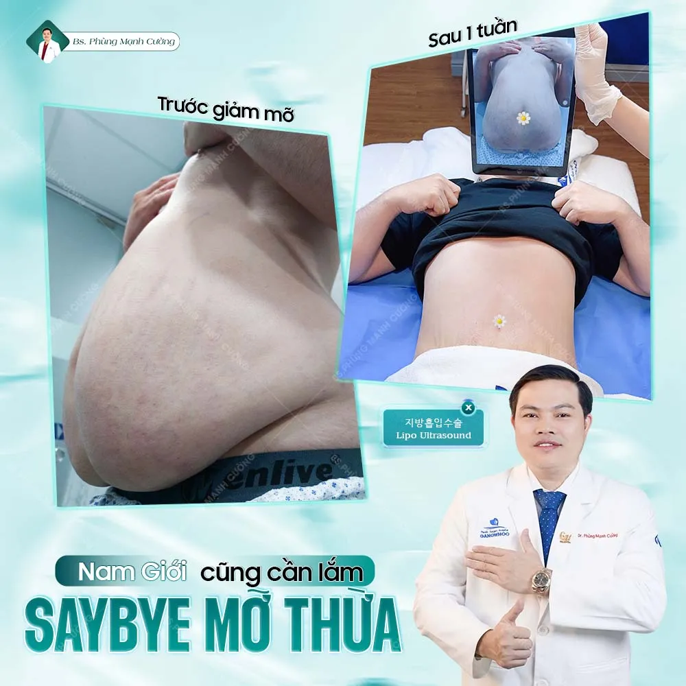 Hút mỡ bụng là gì? Những điều cần biết trước khi thực hiện 45 Hút Mỡ Bụng Toàn Phần An Toàn, Không Đau Cho Vòng Eo Cân Đối