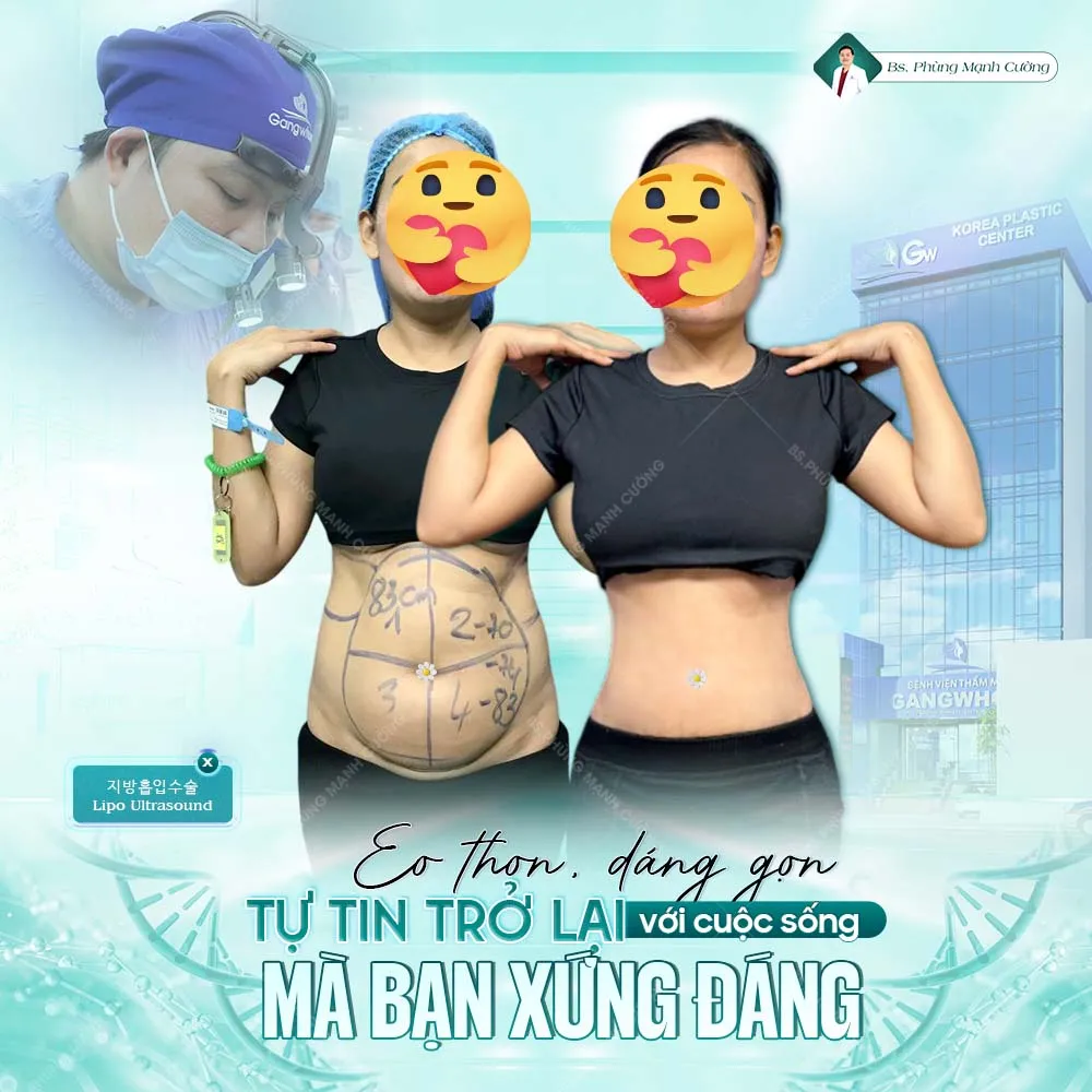Hút mỡ bụng là gì? Những điều cần biết trước khi thực hiện 46 Hút Mỡ Bụng Toàn Phần An Toàn, Không Đau Cho Vòng Eo Cân Đối