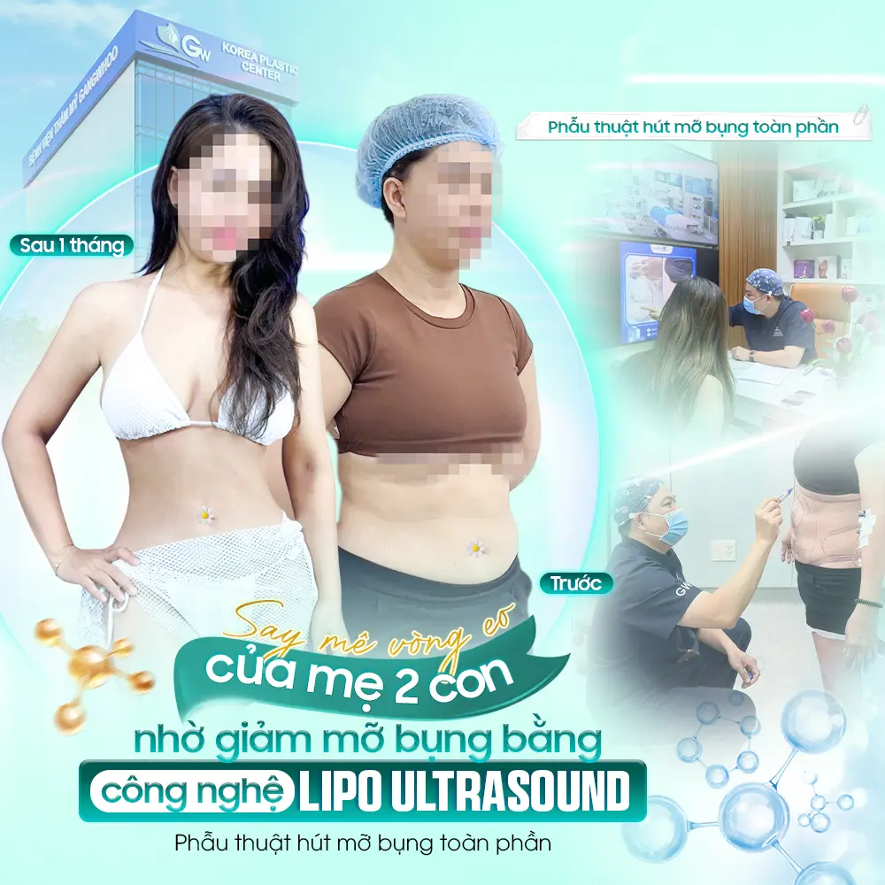 Hút mỡ bụng là gì? Những điều cần biết trước khi thực hiện 53 Hút mỡ bụng là gì? Những điều cần biết trước khi thực hiện