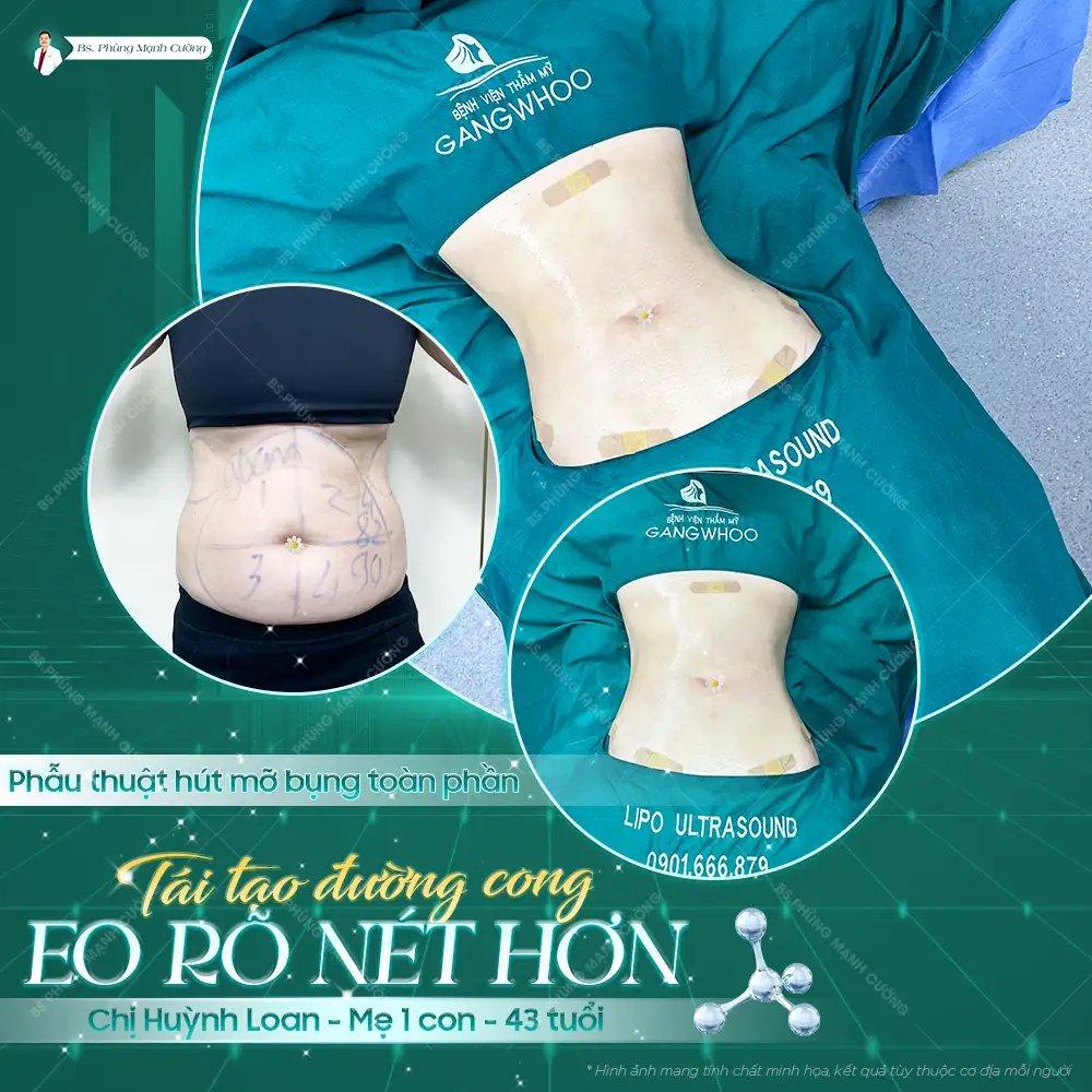 Hút mỡ bụng là gì? Những điều cần biết trước khi thực hiện 54 Hút mỡ bụng là gì? Những điều cần biết trước khi thực hiện