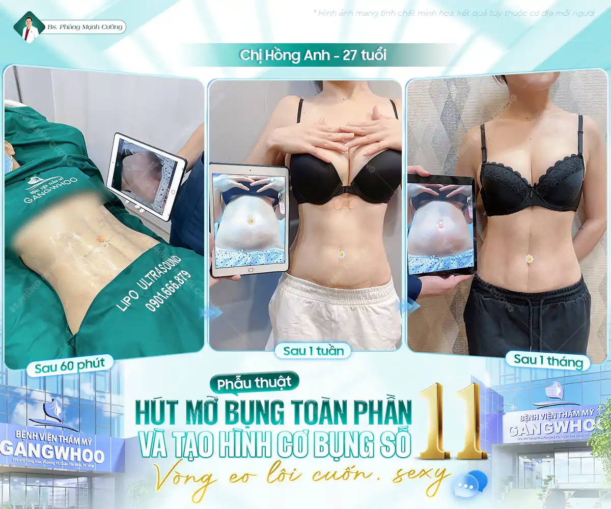 Hút mỡ bụng là gì? Những điều cần biết trước khi thực hiện 55 Hút mỡ bụng là gì? Những điều cần biết trước khi thực hiện