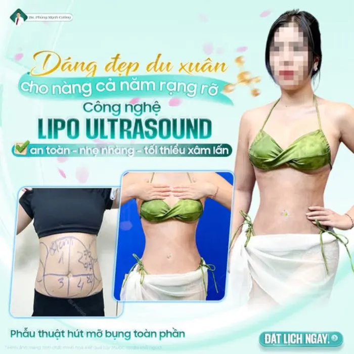 Hút mỡ bụng là gì? Những điều cần biết trước khi thực hiện 29 Hút mỡ bụng là gì? Những điều cần biết trước khi thực hiện