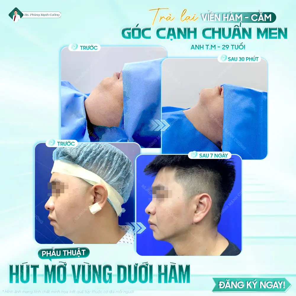 Hút mỡ nọng cằm có những ưu điểm nào?