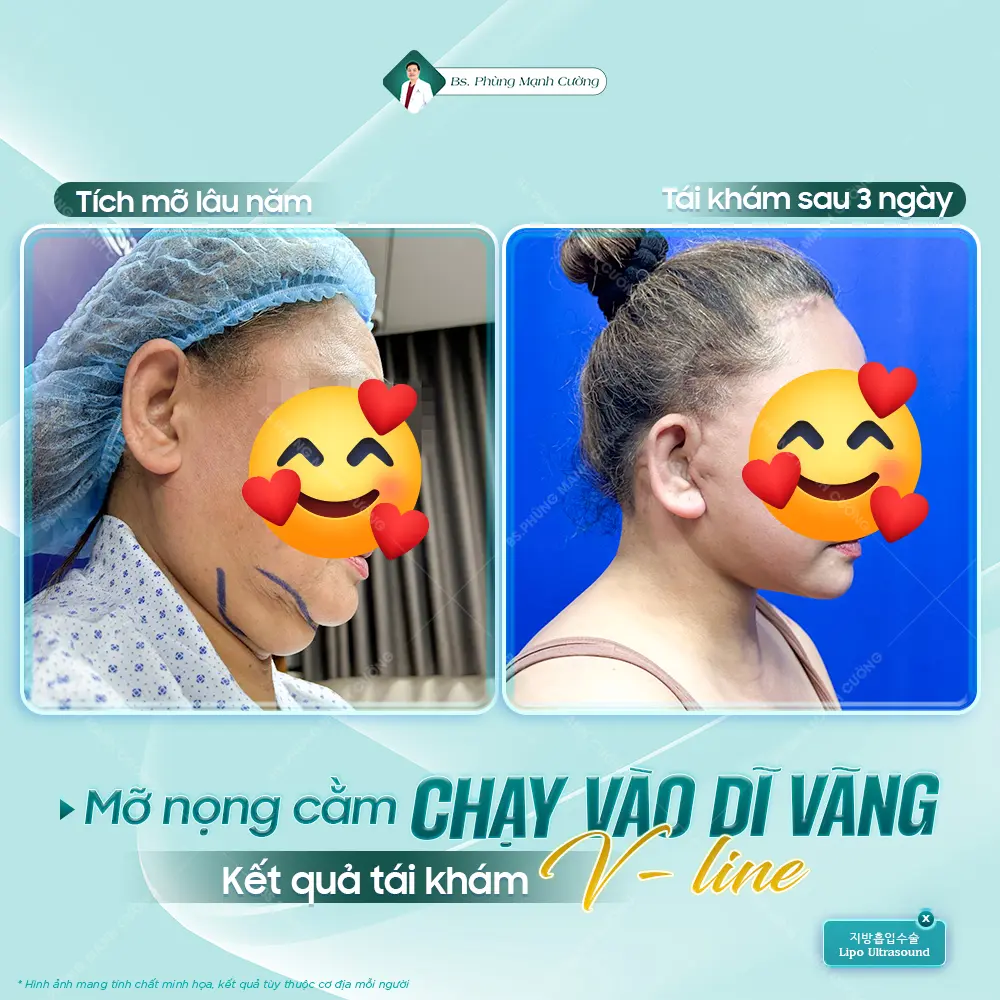 Hút mỡ nọng cằm rất an toàn khi thực hiện tại cơ sở uy tín