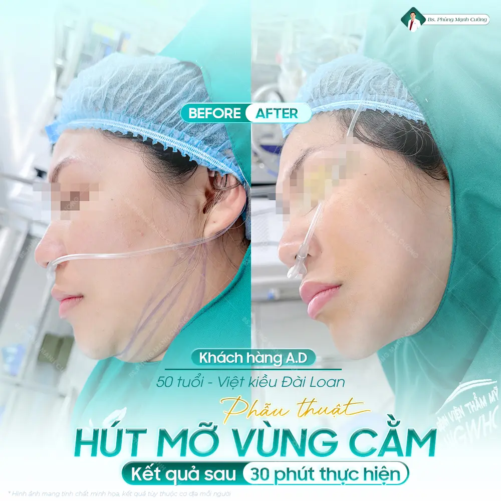 Tìm hiểu về hút mỡ nọng cằm