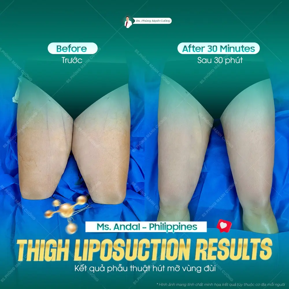 Hút mỡ đùi: Phẫu thuật giảm mỡ, tạo hình thon gọn