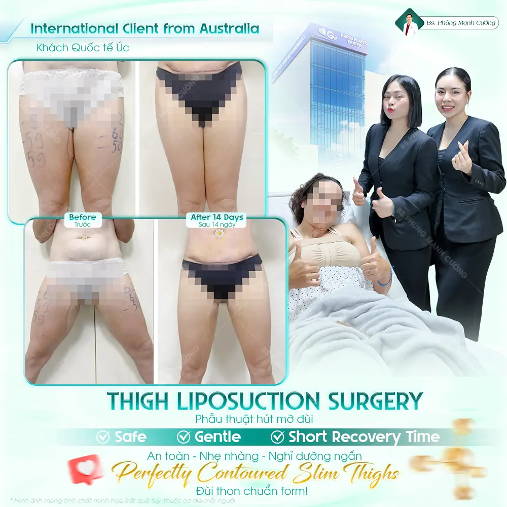 Đối tượng phù hợp với hút mỡ đùi