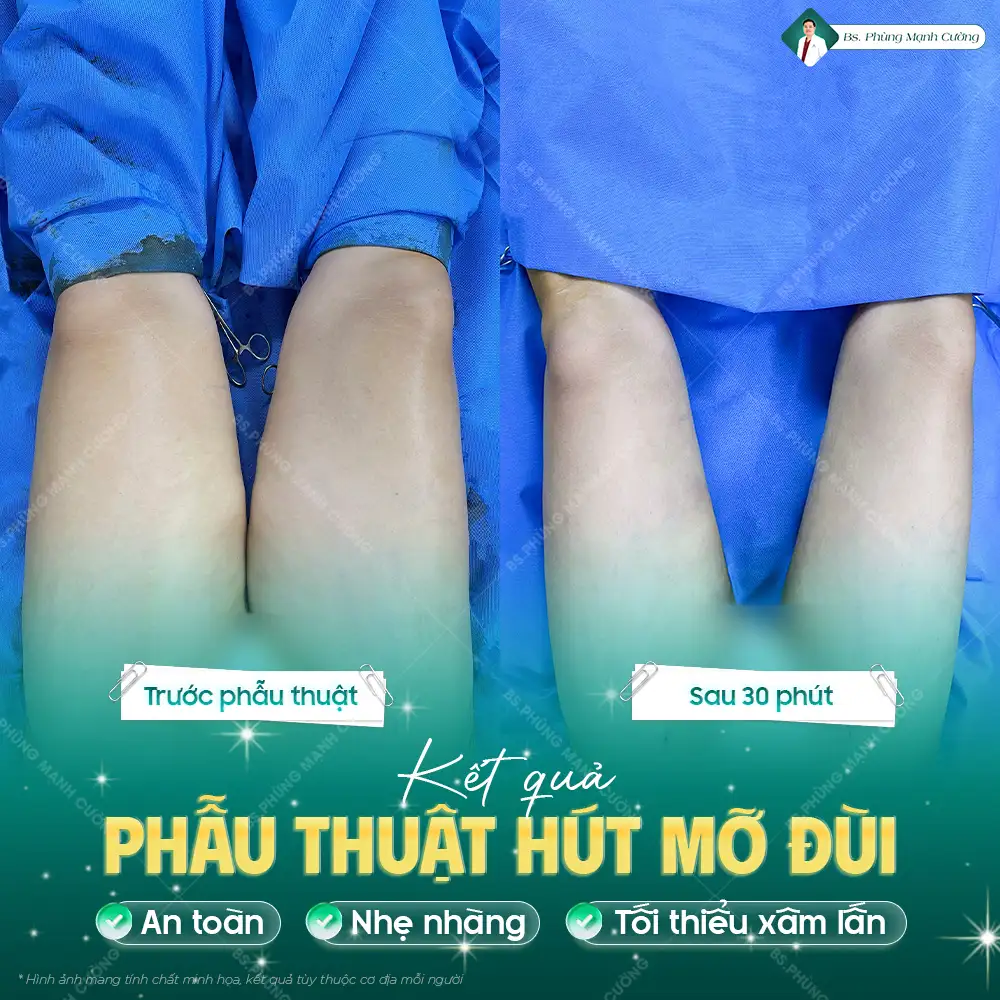 Hút mỡ đùi: Phẫu thuật giảm mỡ, tạo hình thon gọn