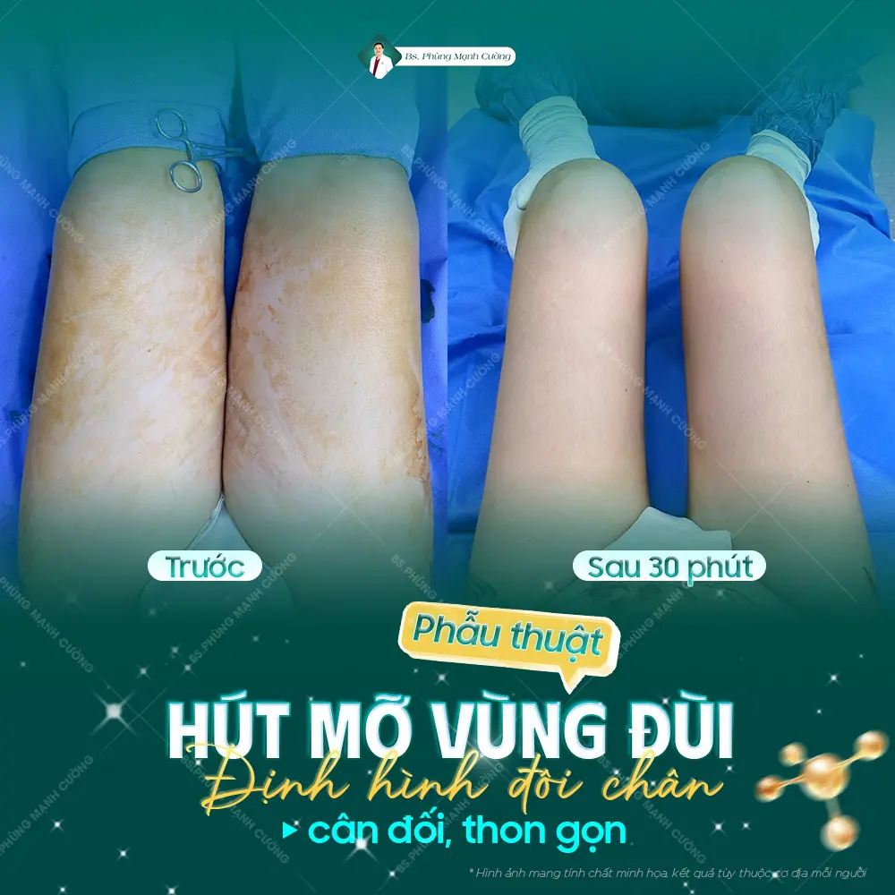Ưu điểm của hút mỡ vùng đùi
