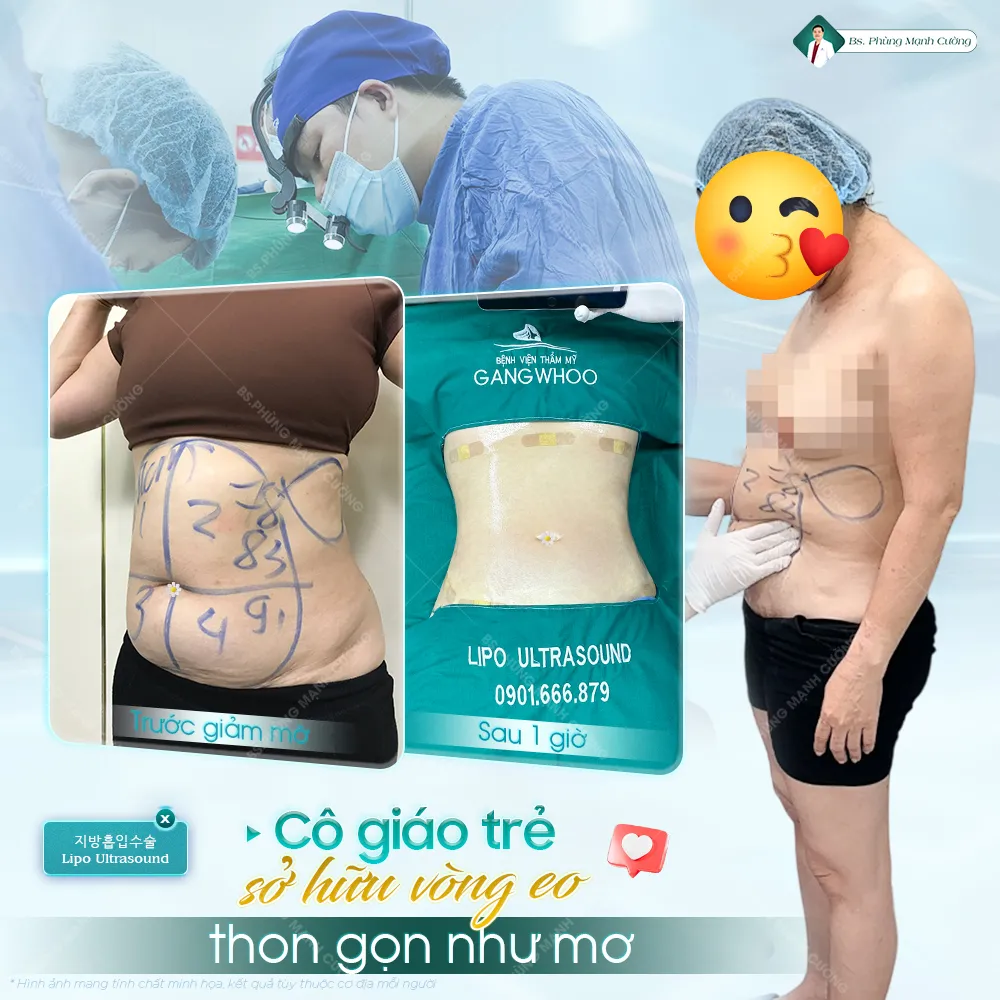 Hút mỡ bụng là gì? Những điều cần biết trước khi thực hiện 28 Lợi ích của phẫu thuật hút mỡ bụng toàn phần