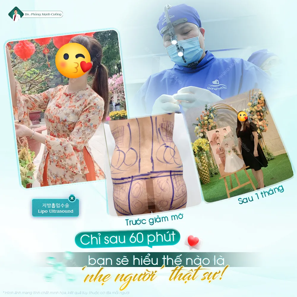 Hút mỡ bụng là gì? Những điều cần biết trước khi thực hiện 48 Hút mỡ bụng là gì? Những điều cần biết trước khi thực hiện