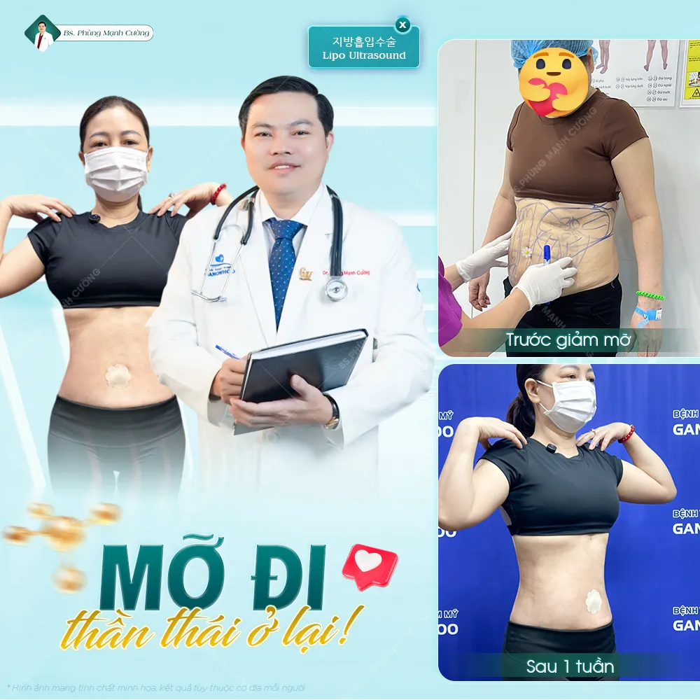 Hút mỡ bụng là gì? Những điều cần biết trước khi thực hiện 49 Hút mỡ bụng là gì? Những điều cần biết trước khi thực hiện