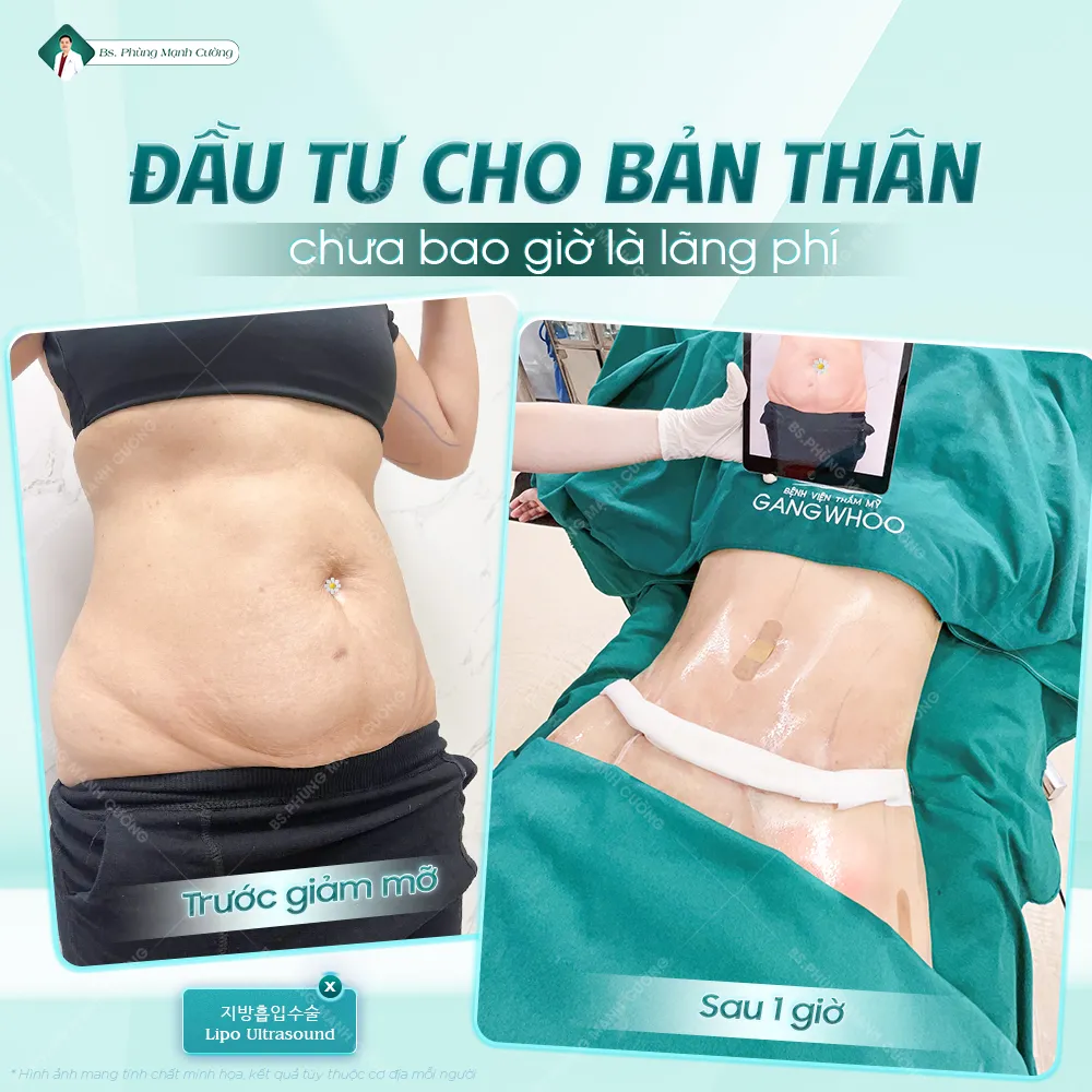 Hút mỡ bụng là gì? Những điều cần biết trước khi thực hiện 51 Hút mỡ bụng là gì? Những điều cần biết trước khi thực hiện