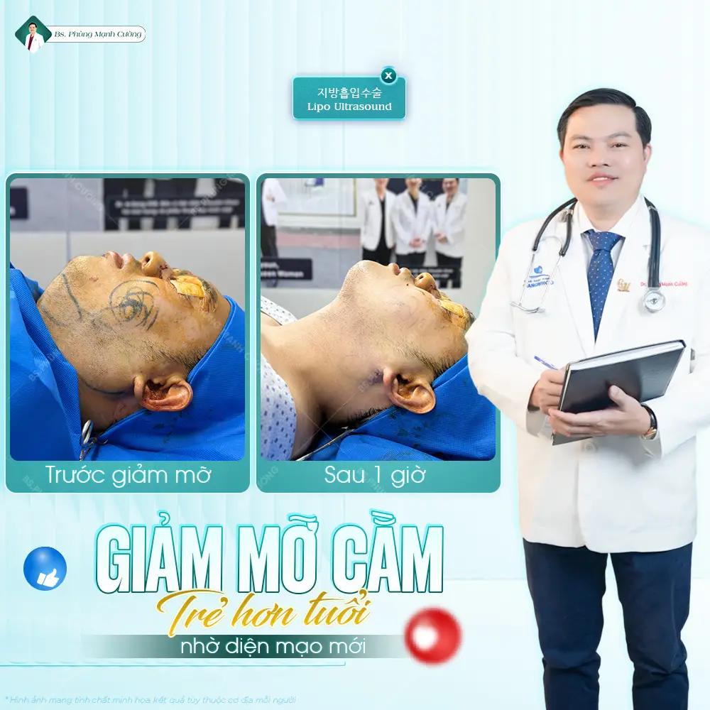 Những điều cần biết về phẫu thuật hút mỡ vùng cằm