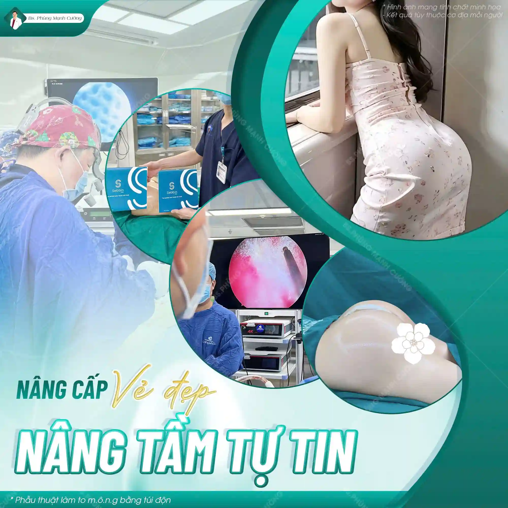 Nâng mông nội soi là gì? Có những lợi ích gì