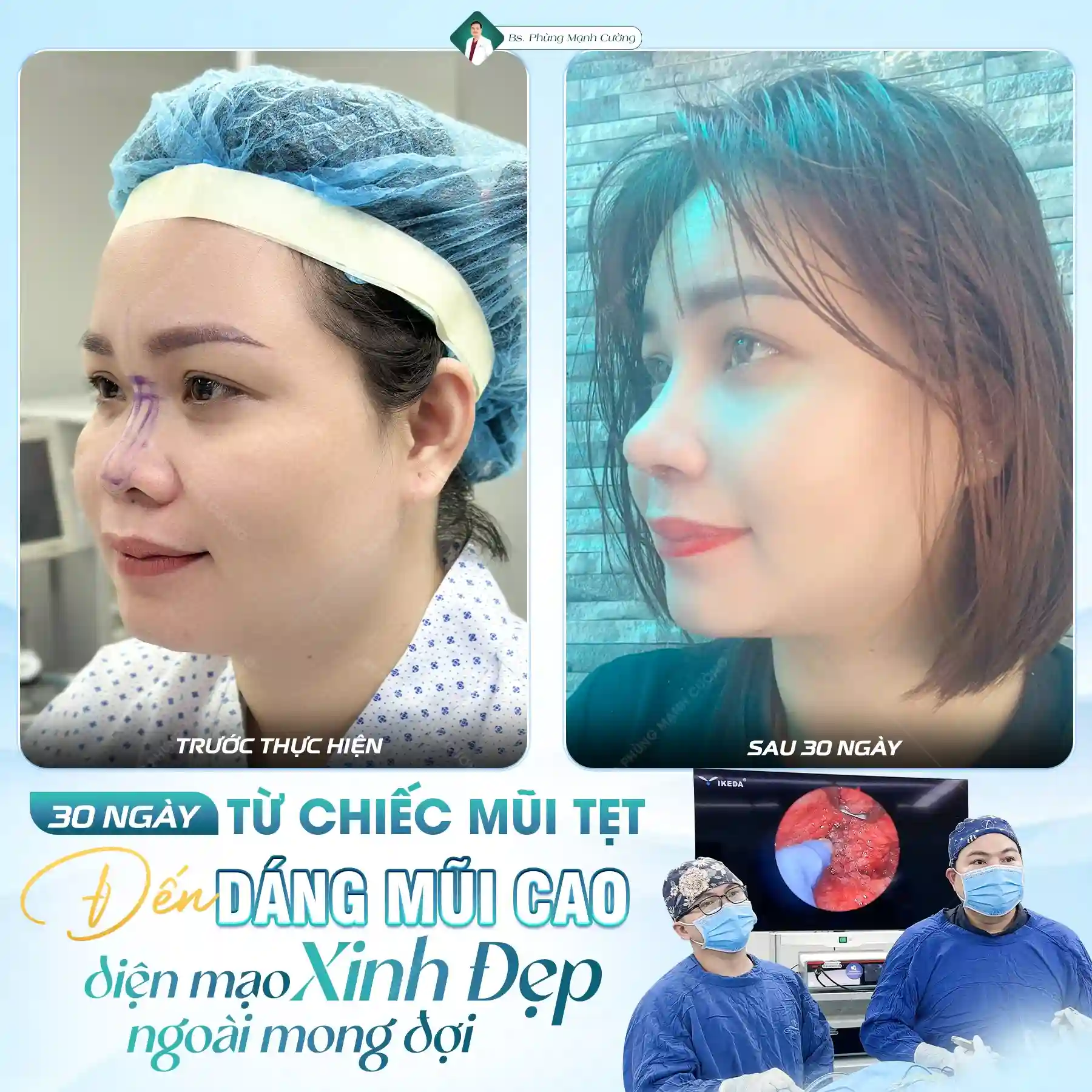 Dáng mũi thường vào form và đẹp tự nhiên trong khoảng từ 3 đến 6 tháng