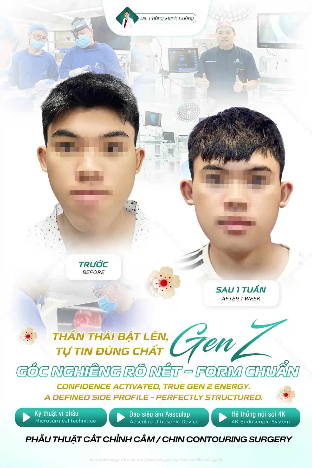 Phẫu thuật trượt cằm là gì? Những điều cần biết về trượt cằm 19 Phẫu thuật trượt cằm thường hồi phục sau 5 - 7 ngày