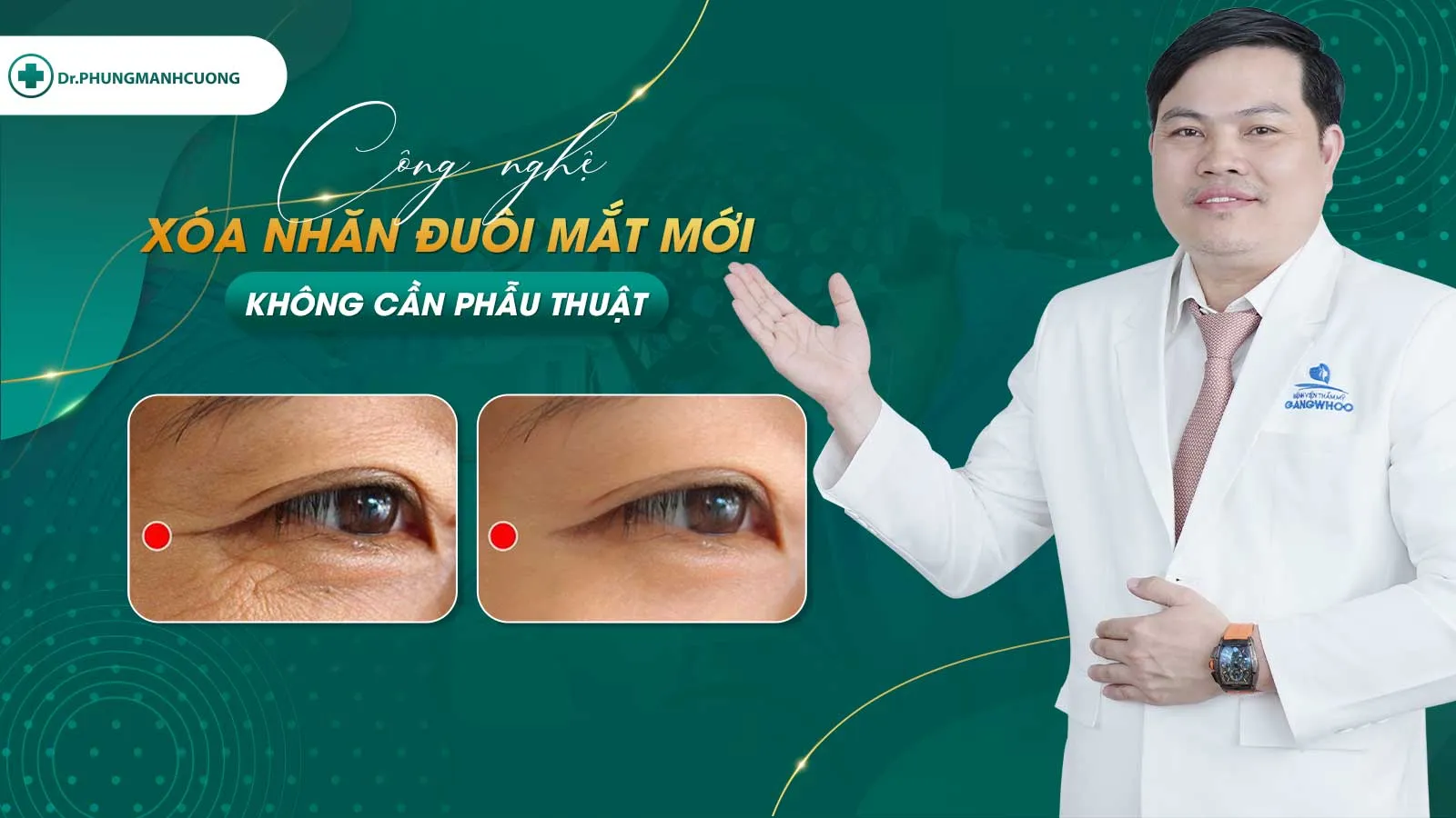 cong nghe xoa nhan duoi mat