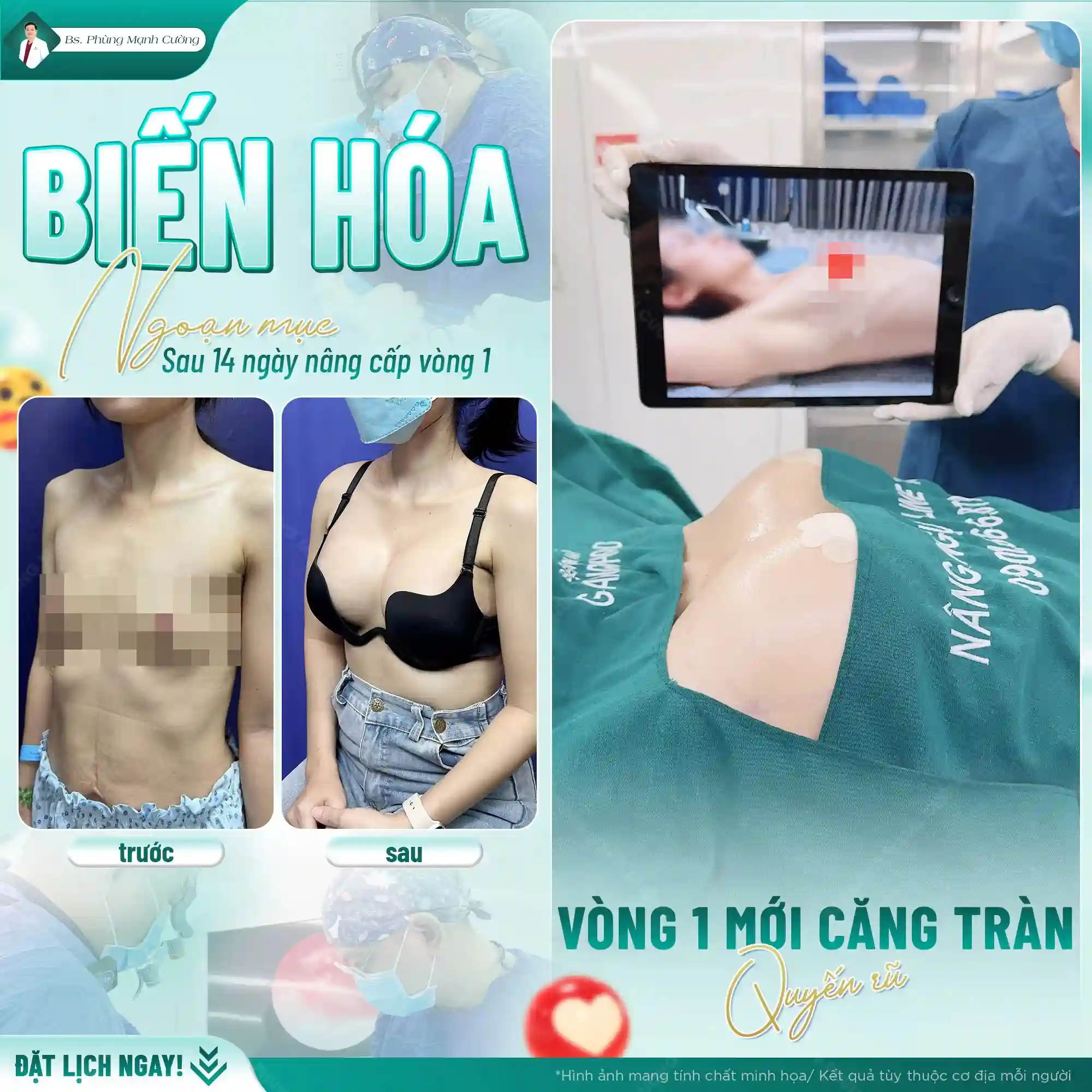 Lưu ý quan trọng sau khi nâng ngực