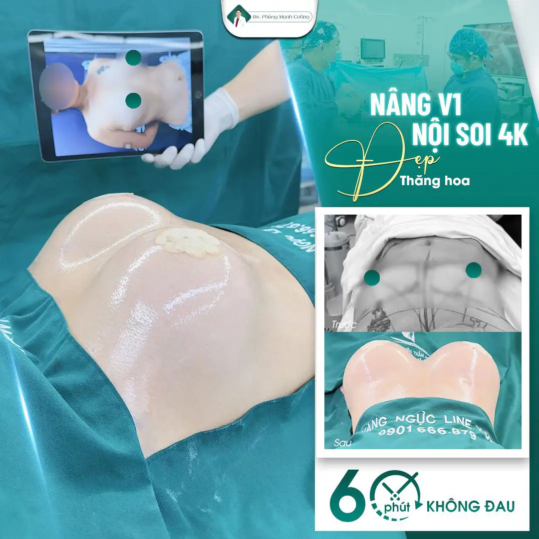 Phương pháp phẫu thuật nâng ngực giúp nâng tầm vẻ đẹp dài lâu