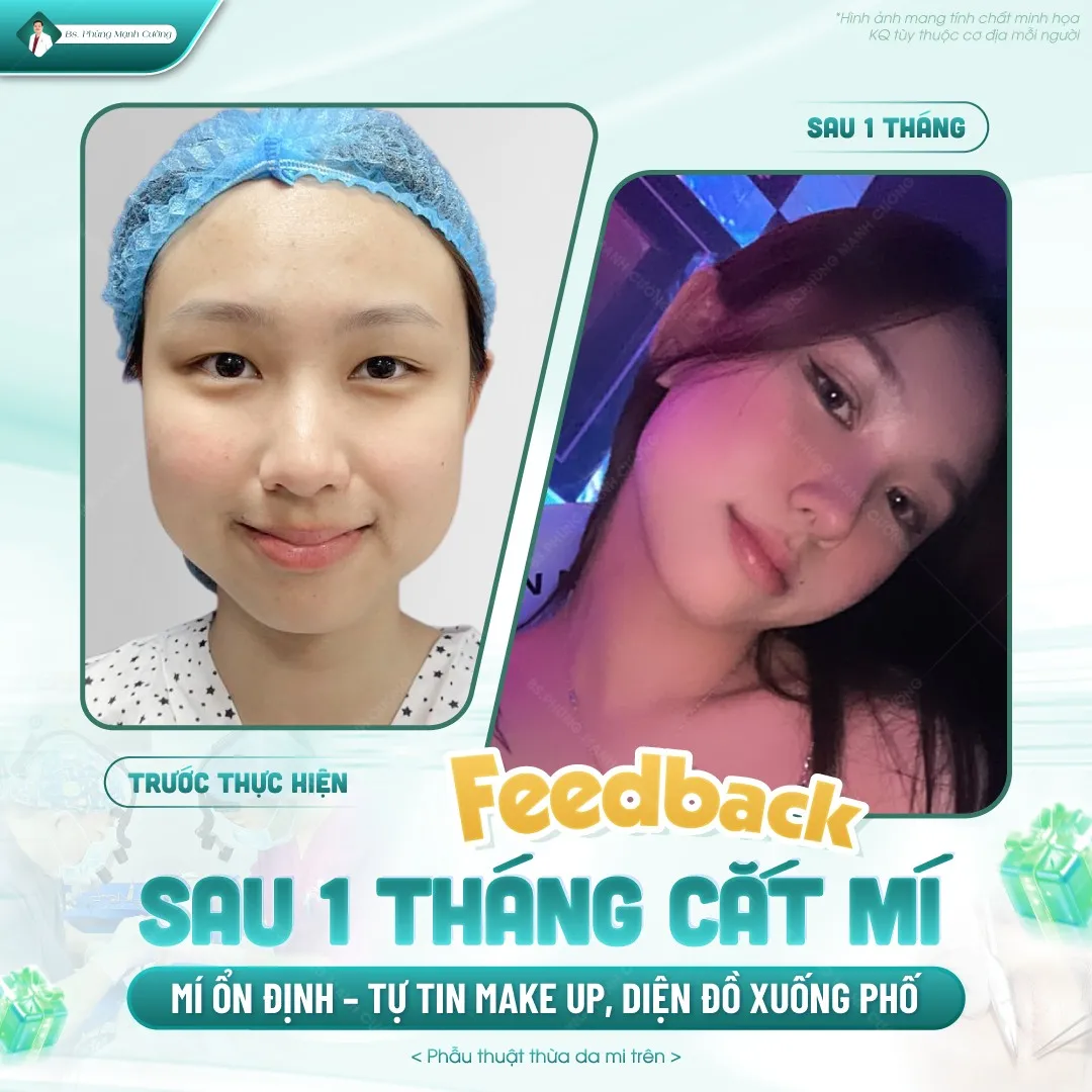 Cắt mắt 2 mí là giải pháp khắc phục mí lót hiệu quả và lâu dài